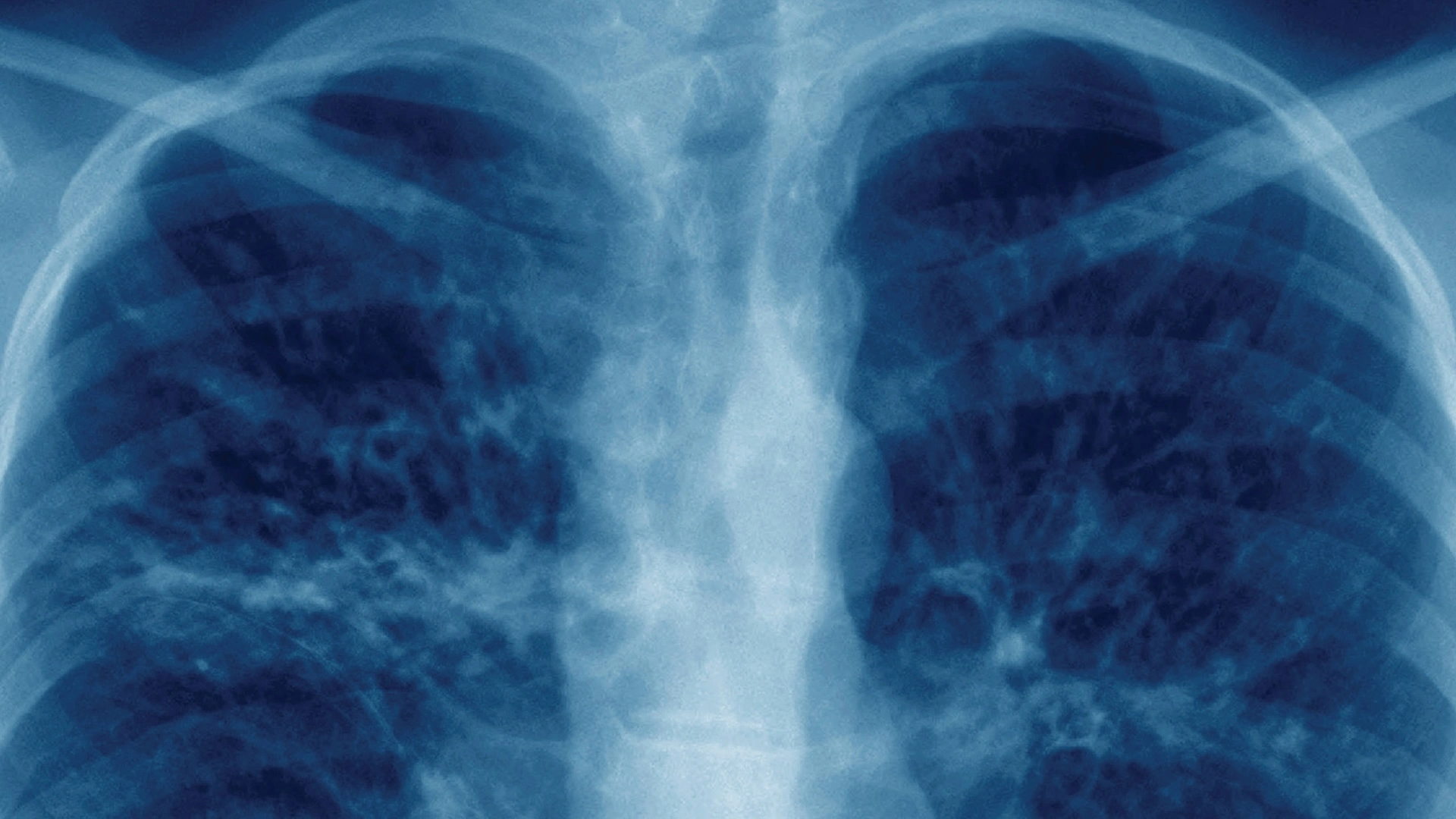 The Battle to Breathe <br/>NOVA